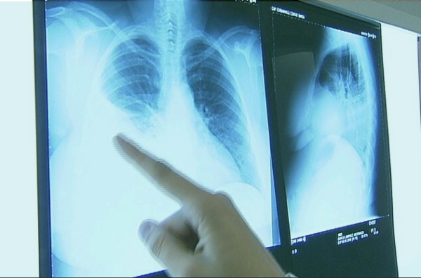 Primera demanda por ansiedad de poder desarrollar una enfermedad vinculada al amianto