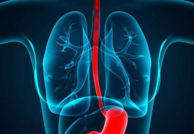 El Supremo señala al amianto como causante del cáncer de esófago de un ex-trabajador de Rocalla