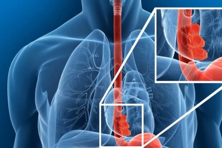 El TSJC admite que la muerte de un trabajador por cáncer de esófago se debe al amianto