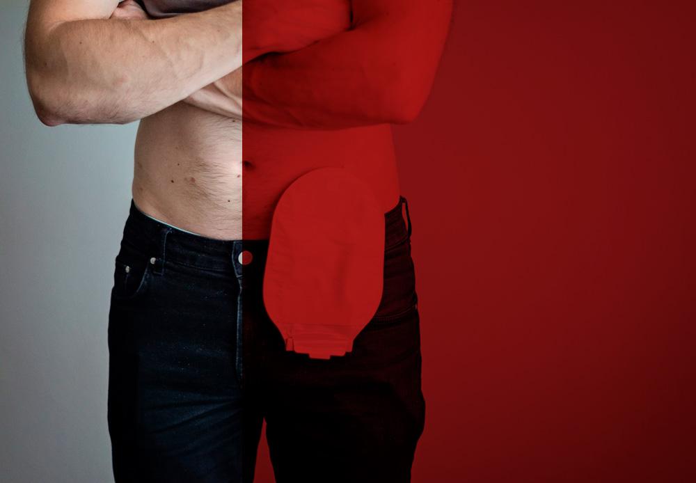 Obliguen a retornar el cost d’una reconstrucció de colon finalitzada a la sanitat privada